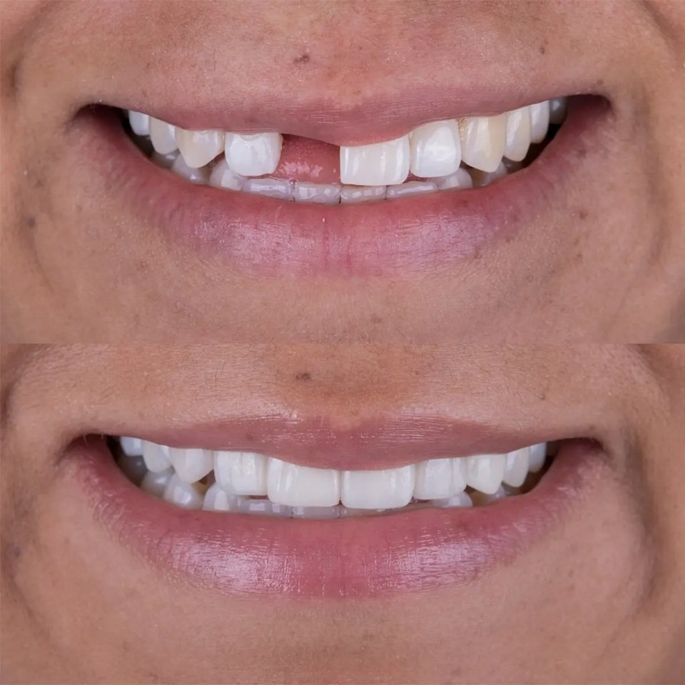 Implantes Dentales